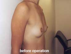 plastic-surgery-breast-augmentation 